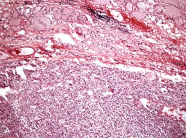 Fig. 29-20, Intraoperative consultation, medullary thyroid carcinoma.