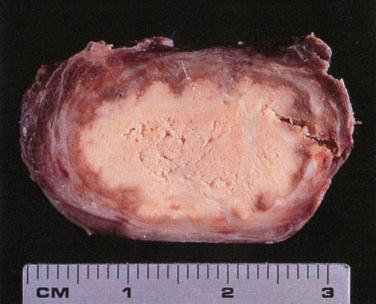 Fig. 29-3, Post-FNAB infarction of a papillary carcinoma.