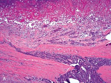 Fig. 29-4, Post-FNAB infarcted papillary thyroid carcinoma (PTC).