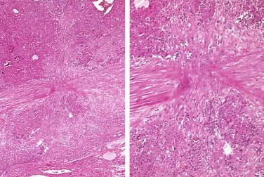 Fig. 29-5, Needle tract and capsular pseudoinvasion.