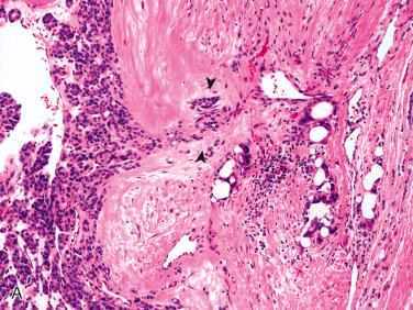 Fig. 29-6, Needle tract with epithelial displacement.