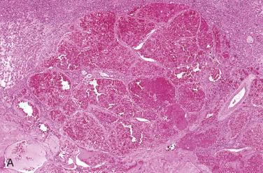 Fig. 29-8, Post-FNAB vascular changes.