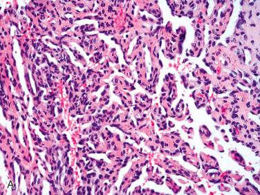 Fig. 29-9, Papillary endothelial hyperplasia.