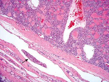 Fig. 29-10, Pseudovascular invasion.