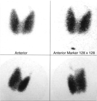 Figure 80-1, Normal 123 I thyroid scan (clockwise from top left: anterior projection, anterior projection with marker in sternal notch, right anterior oblique projection, and left anterior oblique projection).