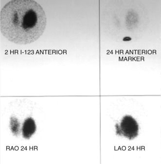 Figure 80-2, Large hot nodule in left thyroid lobe with suppression of right thyroid lobe on 123 I thyroid scan (clockwise from top left: anterior projection, anterior projection with marker in sternal notch, right anterior oblique projection, and left anterior oblique projection).