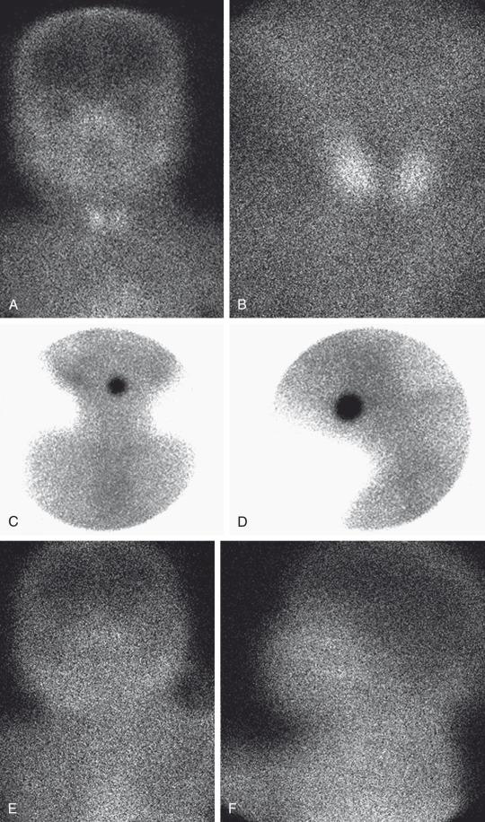 Figure 17.2, Normal and abnormal thyroid scintigraphy.