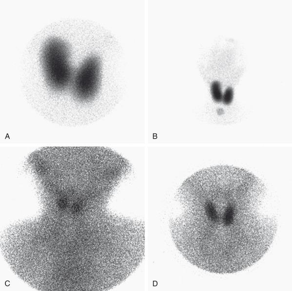 e-Figure 17.3, Abnormal thyroid scans.