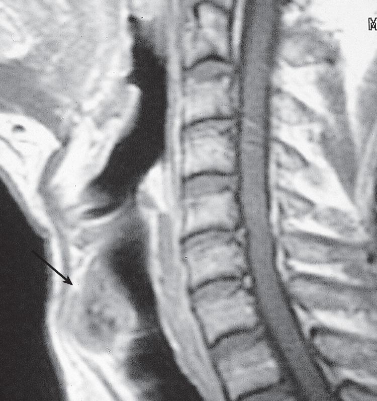 Figure 12.14, A sagittal view of the magnetic resonance imaging scan of the same patient shown in Fig. 12.13 .