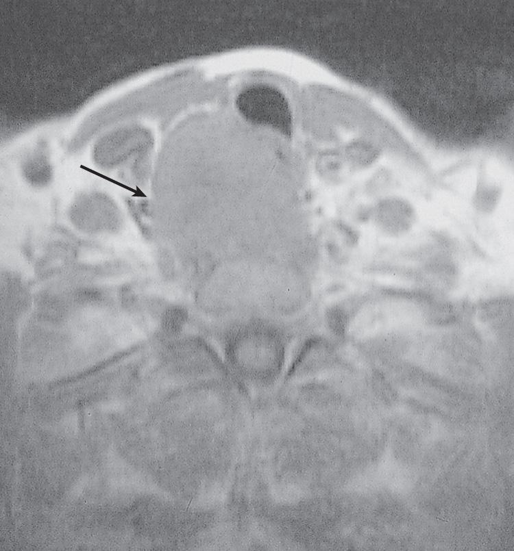 Figure 12.15, An axial view of a magnetic resonance imaging of a patient with recurrent thyroid cancer extending to the prevertebral space ( arrow ).