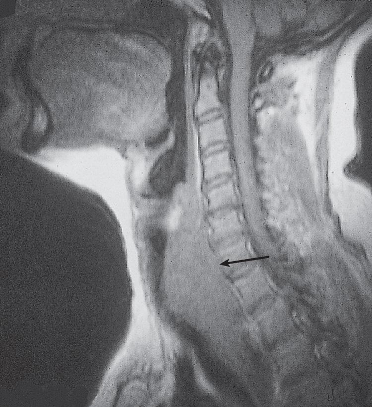 Figure 12.16, A sagittal view of a magnetic resonance imaging scan of the same patient shown in Fig. 12.15 .