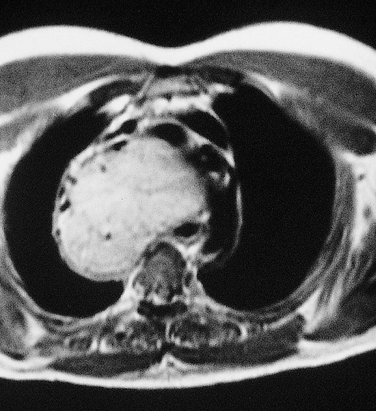 Figure 12.17, An axial view of a magnetic resonance imaging scan showing a large retrosternal goiter in relation to the great vessels.