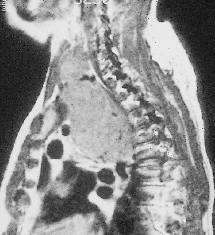 Figure 12.19, A sagittal view of the magnetic resonance imaging scan of the same patient shown in Figs. 12.17 and 12.18 .