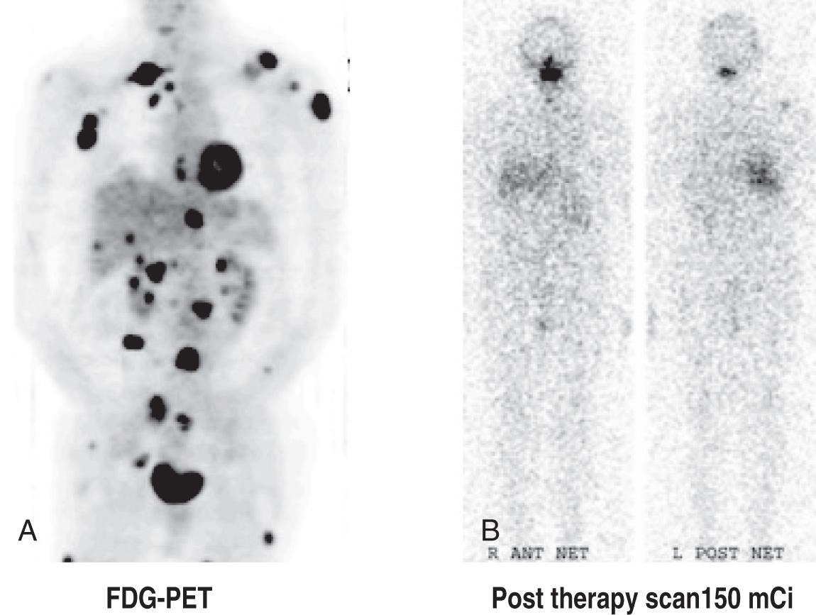 Figure 12.20, A positron emission tomography (PET) scan demonstrating extensive metastatic disease (A) that did not concentrate radioactive iodine (B) . FDG-PET, Fluorodeoxyglucose positron emission tomography.