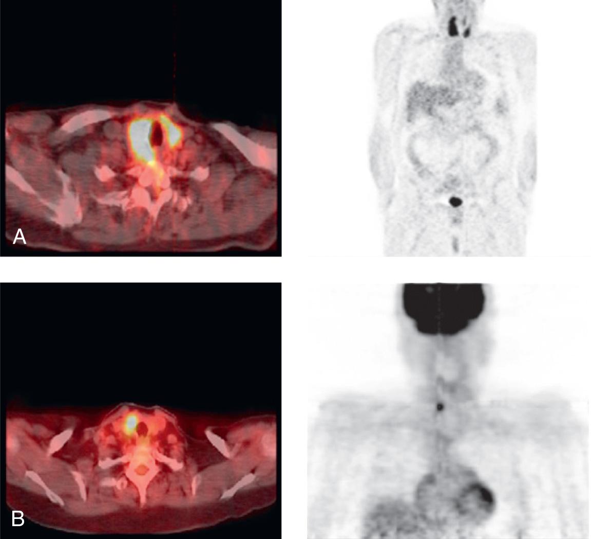 Figure 12.21, 18-Fluorodeoxyglucose positron emission tomography scan showing diffuse uptake ( A ) in a patient with Hashimoto's thyroiditis and focal uptake ( B ) in a patient with papillary carcinoma of thyroid gland.