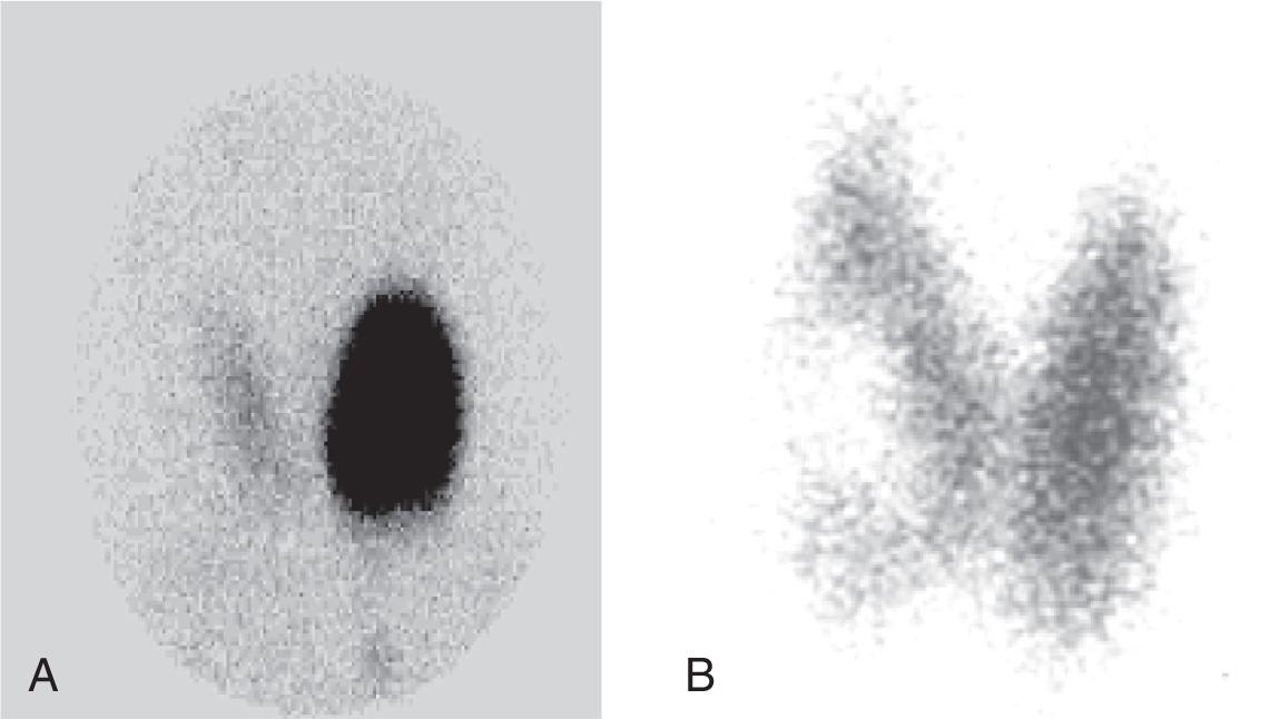 Figure 12.22, I-131 scans showing ( A ) a hot nodule and ( B ) a cold nodule.