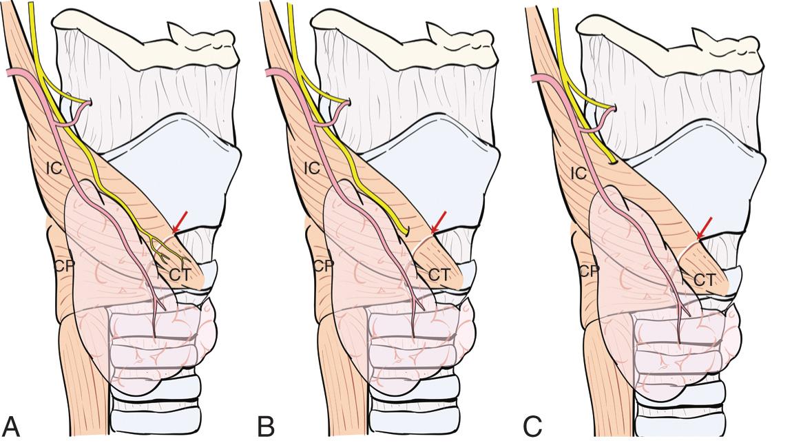 Figure 12.26, Variations in anatomic relations of the external branch of the superior laryngeal nerve (ESLN). A , The ELSN is superficial to the inferior constrictor (IC) muscle and runs along superior thyroid vessels so that it is visible in its entire course up to the cricothyroid (CT) muscle. B , The ESLN pierces the IC muscle approximately 1 cm above the cricothyroid membrane ( red arrow ) so that only its upper portion is at risk for injury. C , The entire ESLN runs deep to the IC muscle and therefore is protected from unintended injury during dissection of the superior thyroid pole.