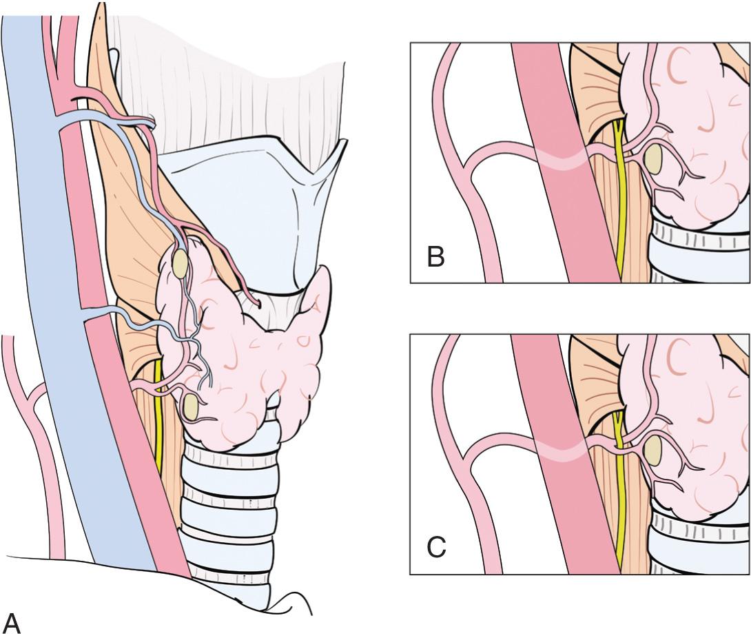 Figure 12.27, Anatomic relationships of the recurrent laryngeal nerve to the inferior thyroid artery. A , Posterior. B , Anterior. C , Between branches of the inferior thyroid artery.