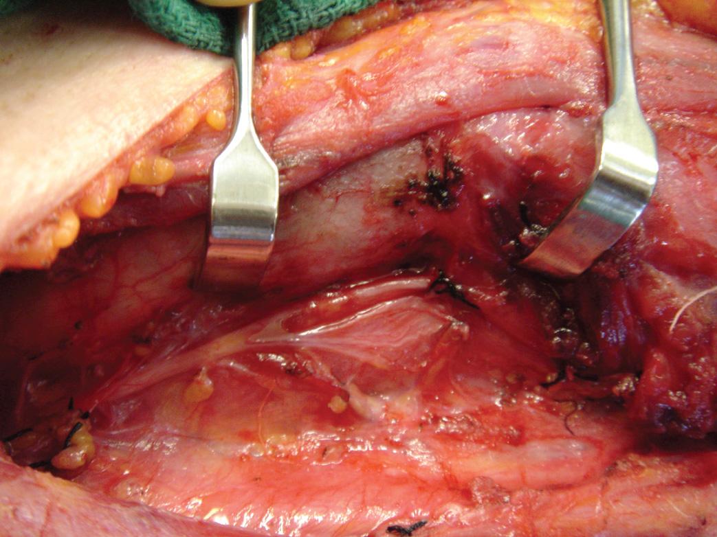 Figure 12.28, The recurrent laryngeal nerve may divide into several branches before entering the larynx.