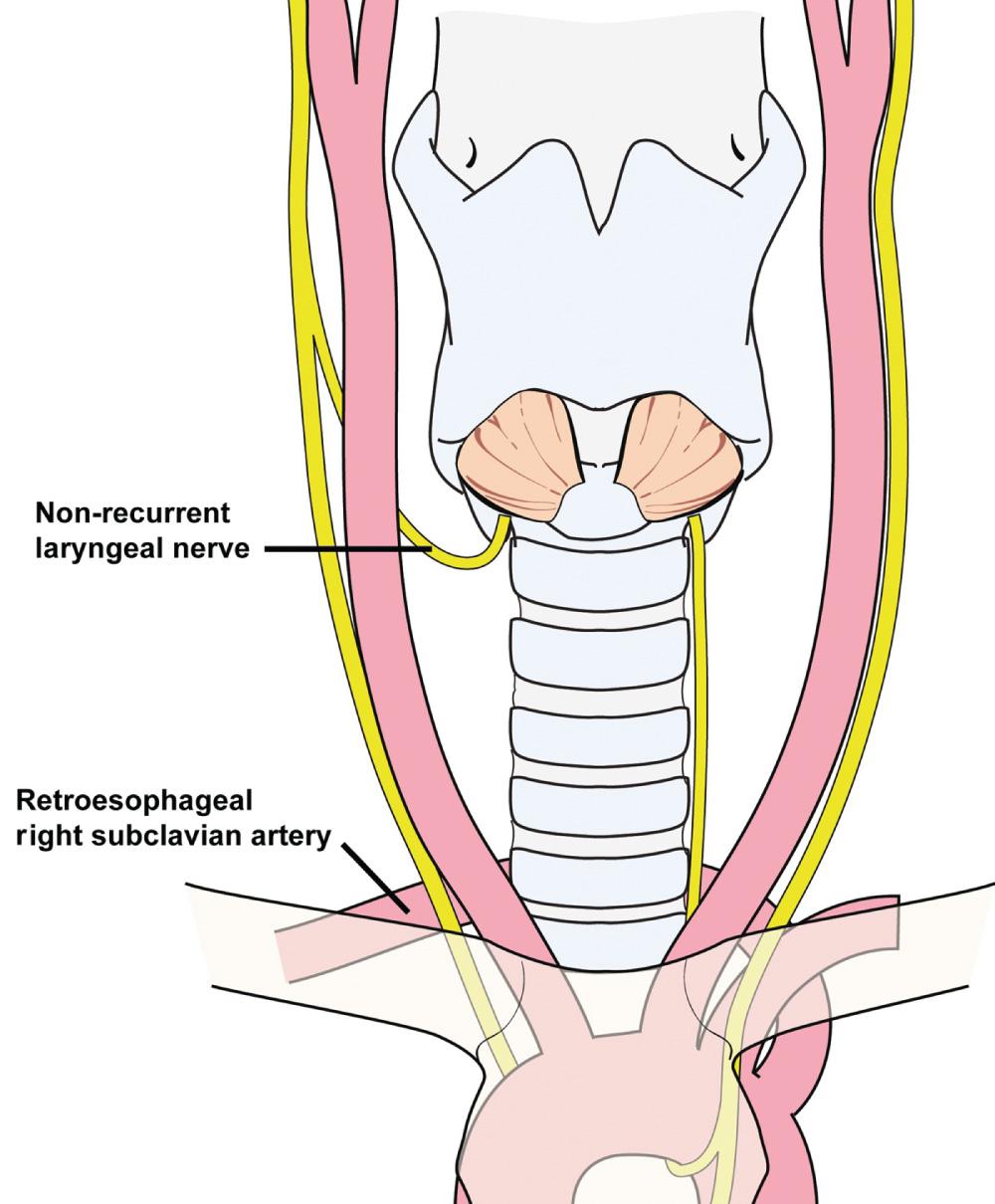 Figure 12.29, Nonrecurrent right inferior laryngeal nerve.