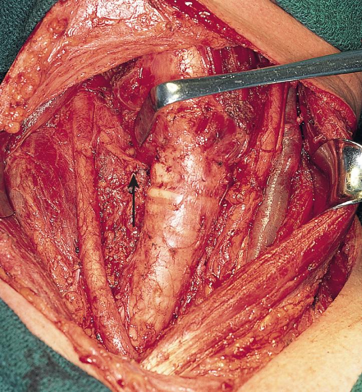 Figure 12.30, Nonrecurrent (inferior laryngeal) nerve, entering the cricothyroid membrane ( arrow ).