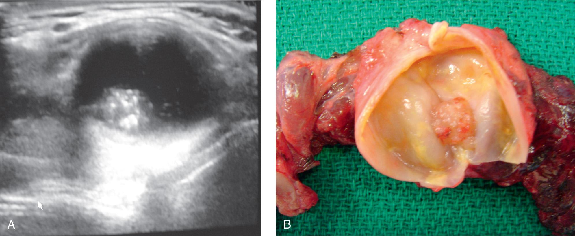 Figure 12.7, A , Sagittal view of the ultrasound of a cystic nodule showing an intracystic lesion with microcalcifications. B , Surgical specimen of the thyroid gland shown in A demonstrating an intracystic papillary carcinoma.