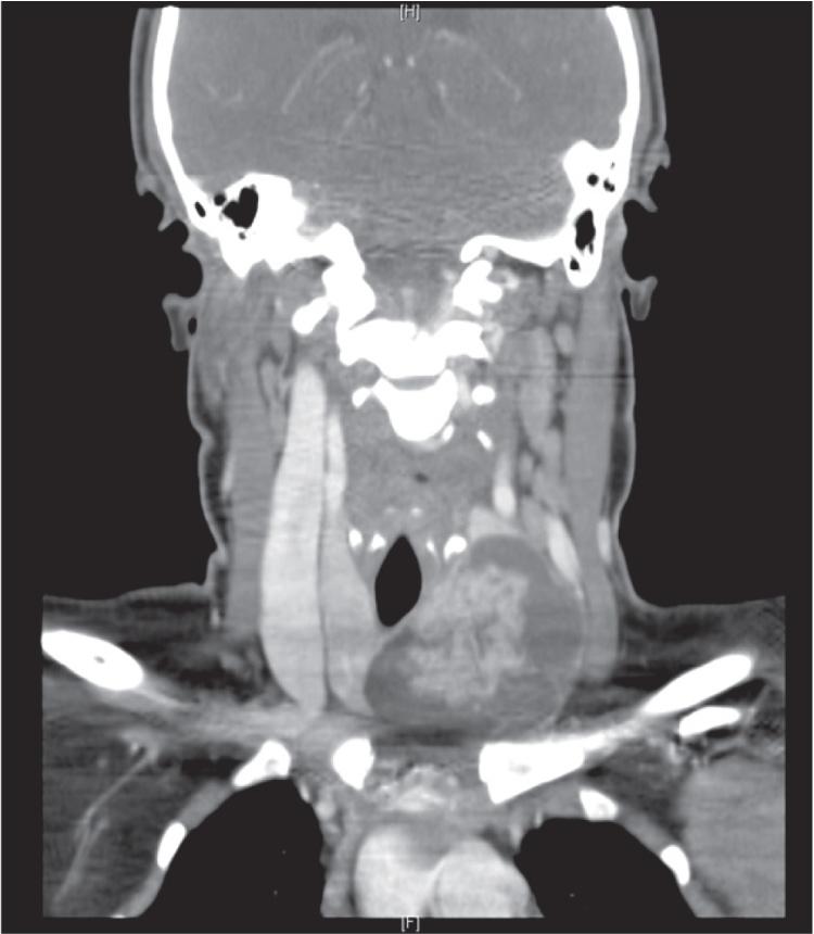 Figure 12.8, Coronal view of a contrast-enhanced computed tomography scan showing a large cystic lesion of the left lobe of thyroid with intracystic papillary carcinoma.