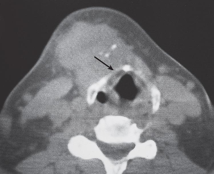 Figure 12.10, A computed tomography scan of the patient shown in Fig. 12.9 .