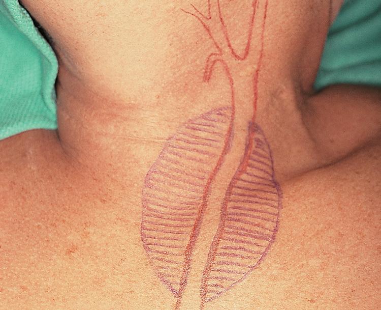 Figure 12.11, A patient with extensive recurrence of carcinoma of the thyroid gland.