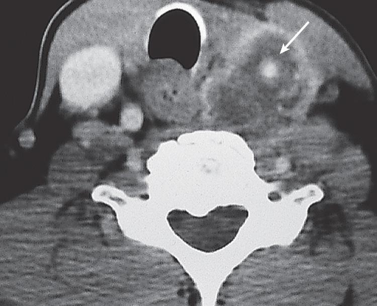 Figure 12.12, A computed tomography scan of the patient in Fig. 12.11 showing encasement of the carotid artery ( arrow ).