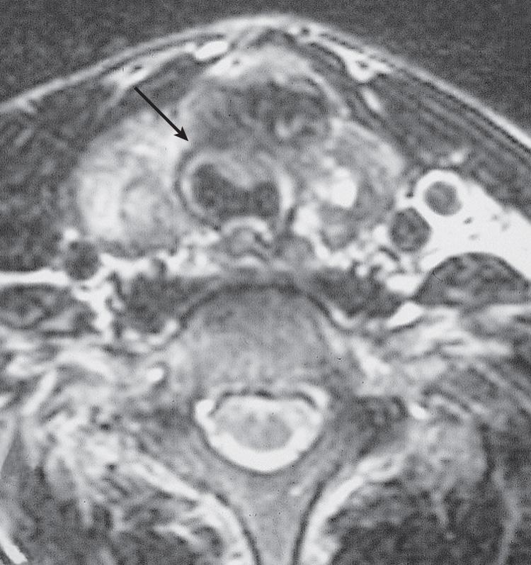 Figure 12.13, An axial view of a magnetic resonance imaging scan of a patient showing invasion of the anterior tracheal wall by thyroid cancer ( arrow ).