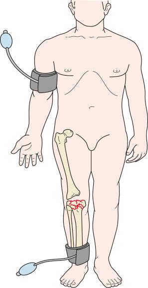 Fig. 62.1, Relative systolic pressure index. Doppler-assisted measurement with blood pressure cuffs on injured and uninjured extremities.