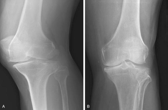 Fig. 62.12, Oblique radiographs of the tibial plateaus provide additional information by eliminating superimposition of lateral views. (A) Internally rotated oblique radiograph, showing posterolateral and anteromedial features, including proximal tibiofibular joint. (B) Externally rotated oblique radiograph, bringing posteromedial and anterolateral regions into profile.