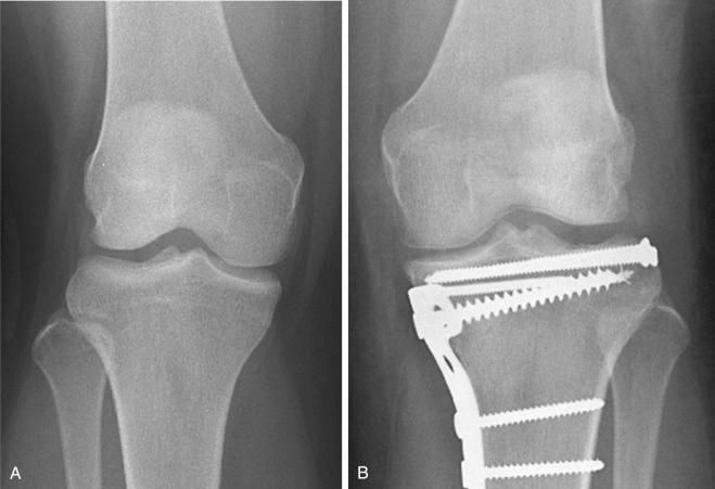 Fig. 62.13, Example of joint line obliquity (tibia varum), present bilaterally. (A) Noninjured extremity comparison view. (B) Injured extremity status after open reduction and internal fixation. Note that the joint lines are neither horizontal nor perpendicular to the tibia shaft.