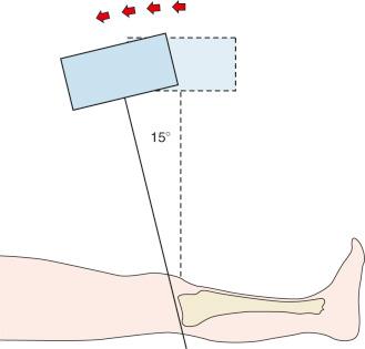 Fig. 62.14, Technique for a tibial plateau anterior-posterior radiograph. The central radiograph beam is aligned tangential and parallel to the proximal tibia. X-ray beam angulation equals that of the anterior-to-posterior obliquity of the tibial plateaus.