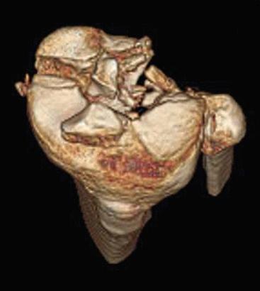 Fig. 62.16, Example of three-dimensional computed tomography image showing severe posterior comminution, which is hard to distinguish on standard two-dimensional views.