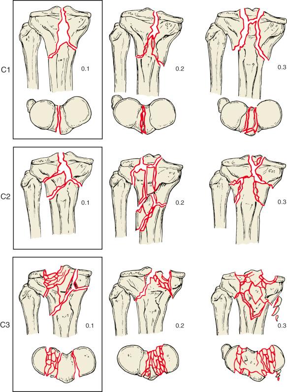 Fig. 62.18, Arbeitsgemeinschaft für Osteosynthesefragen (AO)/Orthopaedic Trauma Association (OTA) type C fractures. Group C1, complete articular fracture, articular simple, metaphyseal simple. This includes fractures with an intact anterior tibial tubercle and intercondylar eminence, fractures involving the anterior tibial tubercle, and fractures involving the intracondylar eminence. The subgroups are 0.1, slight displacement; 0.2, one condyle displaced; and 0.3, both condyles displaced. Group C2, complete articular fracture, articular simple, metaphyseal multifragmentary. The subgroups are 0.1, intact wedge (lateral and medial); 0.2, fragmented wedge (lateral and medial); and 0.3, complex. Group C3, complete articular fracture, multifragmentary. This includes metaphyseal simple, metaphyseal lateral wedge, metaphyseal medial wedge, metaphyseal complex, and metaphyseal-diaphyseal complex fractures. The subgroups are 0.1, lateral; 0.2, medial; and 0.3, lateral and medial. Schatzker types V and VI correspond to the AO type C1 fractures. Subgroups C1.1, C1.2, and C1.3 correspond to the Schatzker type V.