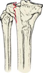 Fig. 62.20, Schatzker type II tibial plateau fracture. A type II fracture involves a split fracture of the lateral condyle with associated impaction and depression of the lateral articular surface. The depressed fragment is often comminuted.