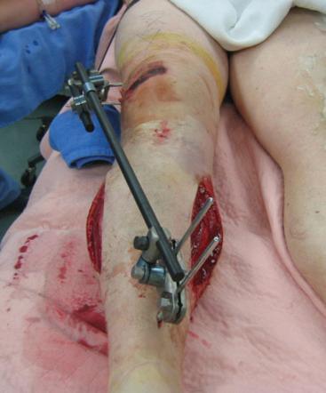 Fig. 62.2, In this case of a nondisplaced tibial plateau fracture, a compartment syndrome was diagnosed by a clinical examination. A fasciotomy was emergently performed to treat the compartment syndrome. Note the bulging muscle herniating through the fasciotomy wounds.