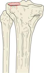 Fig. 62.21, Schatzker type III tibial plateau fracture. A type III fracture involves a pure depression of the lateral articular surface only. There is no associated metaphyseal condylar fracture line. Instability may not be present when the depressed area is small or centrally located.