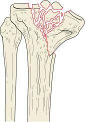 Fig. 62.22, Schatzker type IV tibial plateau fracture. A type IV fracture involves a split fracture of the medial plateau with associated comminution of the intracondylar eminence or medial plateau articular surface.