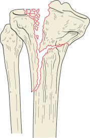 Fig. 62.24, Schatzker type VI tibial plateau fracture. The feature in this fracture pattern is the complete dissociation between the articular surface and the diaphysis. Impaction of the articular surface is common in this fracture pattern, usually involving the lateral plateau.