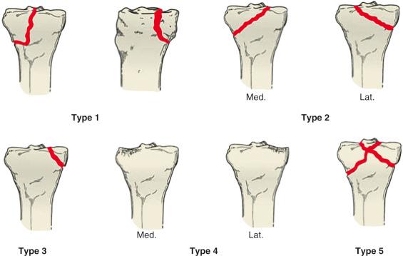 Fig. 62.25, Moore classification. Lat., Lateral; med., medial.