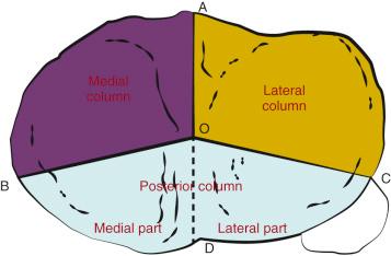 Fig. 62.26, This three-column classification, primarily computed tomography based, divides the tibial plateau into the medial column (purple), the lateral column (yellow), and the posterior column (aqua) (subclassified as medial part or lateral part).