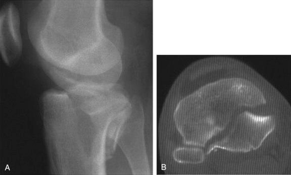 Fig. 62.27, Posterior shear fracture of the tibial plateau. (A) Plateau fracture demonstrating subluxation of the distal femur in association with a coronal plane fracture. (B) Computed tomography scan demonstrating the involvement of the posterior half of the tibial condyles, which requires a posterior approach for fixation to prevent further subluxation.