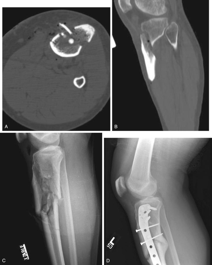 Fig. 62.4, (A) An axial computed tomography scan approximately 2 cm below the joint line of a comminuted tibial plateau fracture. Do you recognize the fractured tibial tubercle? (B) This coronal view through the tubercle on the same patient clearly displays a displaced tibial tubercle fracture. (C) Lateral radiograph of another patient demonstrating an anterior fragment that includes the tibial tubercle. (D) A lateral view of the same knee after healing of the fragment. Fixation is advisable to prevent displacement and nonunion caused by tension on the patellar ligament.