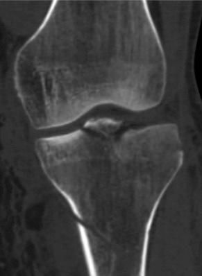 Fig. 62.5, Intercondylar eminence fracture, which can be best visualized on the coronal computed tomography scan.