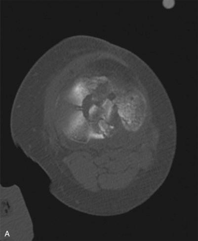 Fig. 62.6, These computed tomography images detail the tibial spine fractures in a complex bicondylar variant. The axial view (A) shows complex bicondylar articular involvement, and the coronal view (B) details the tibial spine avulsed from its origin. These C-arm images show intraoperative final fixation using a strategy to capture the tibial spines and lagging them into their origin. There is a screw scaffolding through the lateral metaphysis where the patient had sustained substantial joint line depression (C and D).