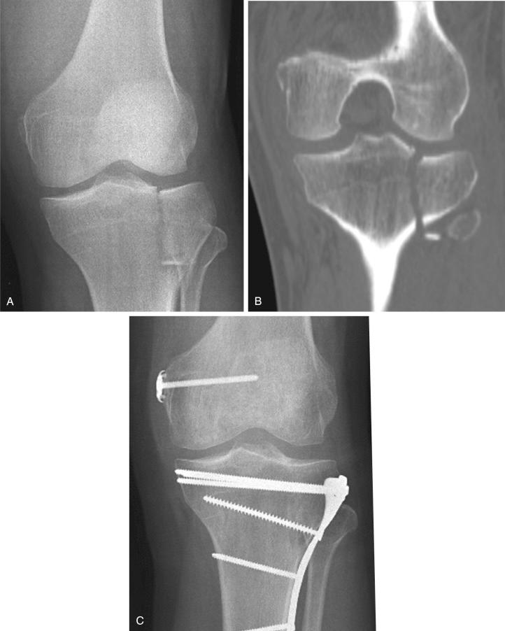Fig. 62.7, Example of Schatzker type II lateral plateau fracture with medial collateral ligament (MCL) avulsion. (A) Preoperative anterior-posterior (AP) radiograph. Note the proximal MCL avulsion. (B) Preoperative computed tomography (CT) scan. Note that the proximal MCL avulsion is seen better by CT. (C) Postoperative AP view of the MCL avulsion reattached at the time of open reduction and internal fixation of the plateau.