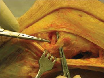 Fig. 62.9, Posterolateral corner structures. Lateral view of the left knee (cadaveric model). The hemostat on the left is pointing to the popliteus attachment on the femur. The superficial layer of the iliotibial band split (to the right) is under the fibular (lateral) collateral ligament. The arcuate complex and the popliteal fibular ligament are deeper, posteriorly.